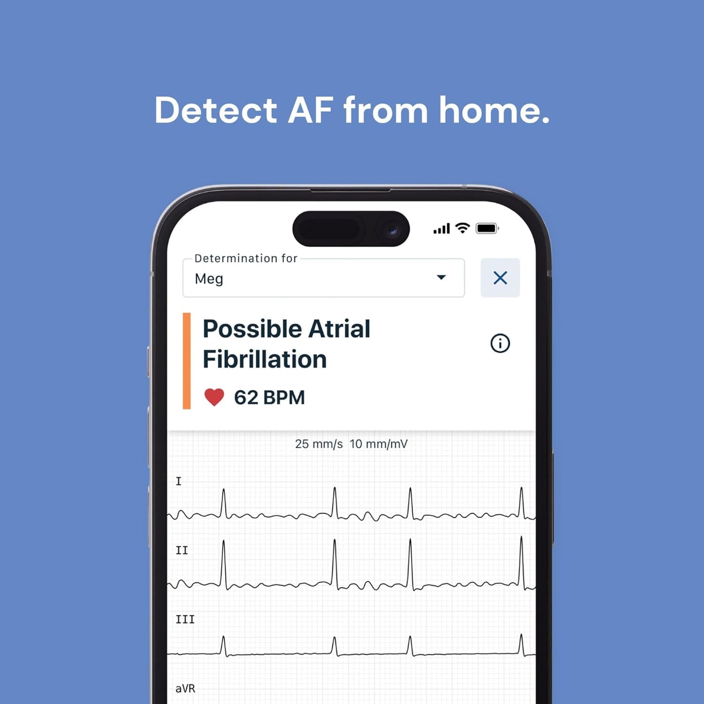 Smart Portable 6-Lead Personal ECG Heart Rate Monitor - Detects Atrial Fibrillation, Trusted by the NHS, Results in 30 Seconds, Works with Most Smartphones, Supporting British Heart Foundation
