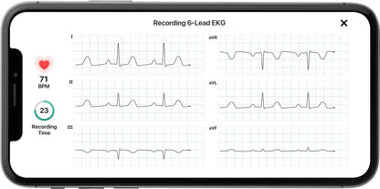 Portable ECG Monitor Bluetooth EKG Heart Tracker Device Accurate Fast Results 6-Lead with AFib Detection